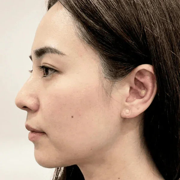 Acu Pyramid - Non-Invasive Acupressure Stimulator Patch - Standard Size - 200 units/Box