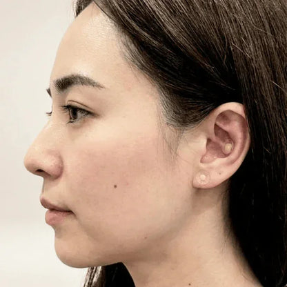 Acu Pyramid - Non-Invasive Acupressure Stimulator Patch - Standard Size - 200 units/Box